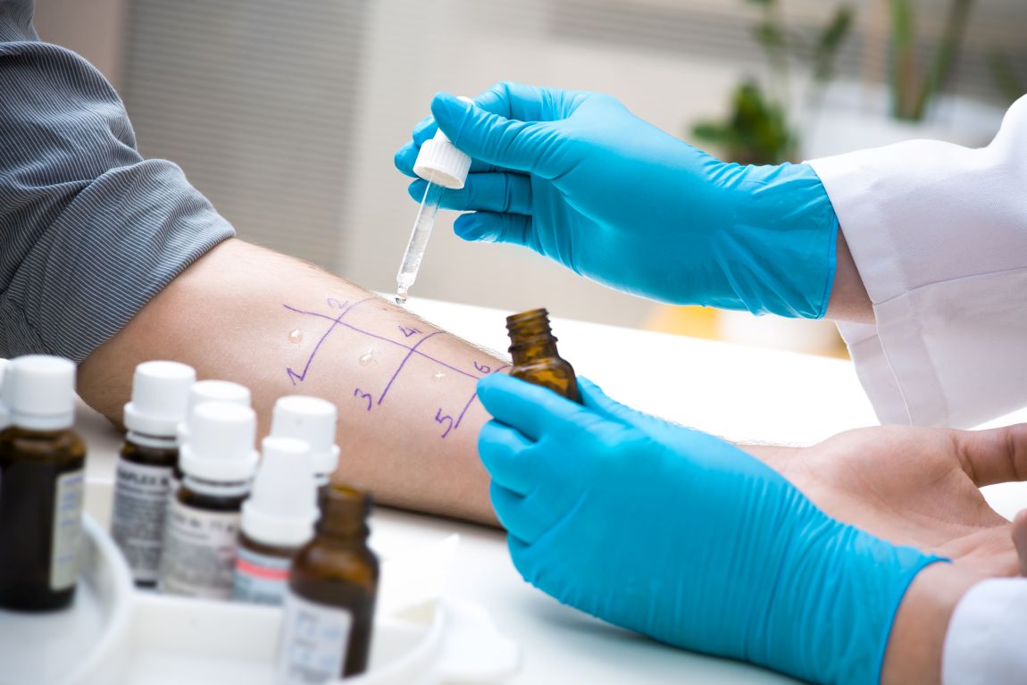closeup of allergy test on arm